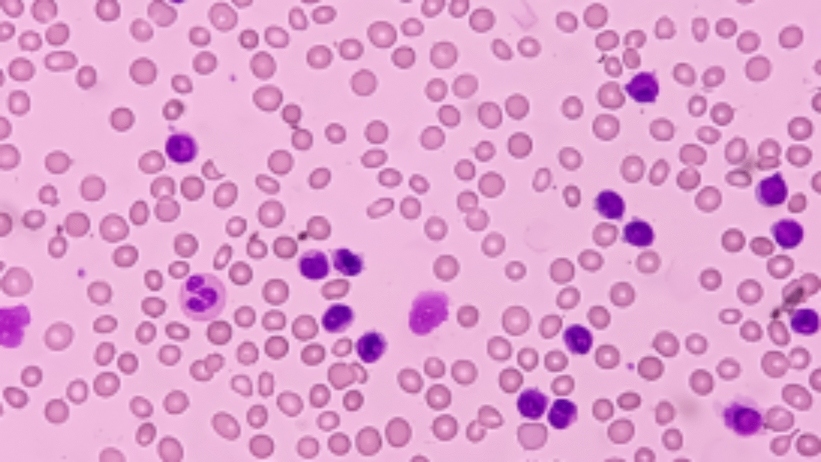 Lymfocytose